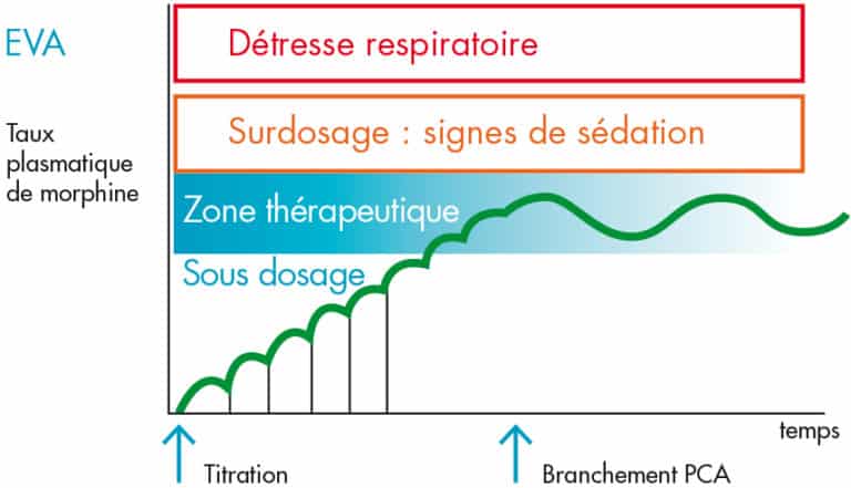 Pose d'une Pompe PCA : morphine prise en charge de la douleur aiguë