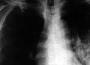 Doit-on craindre un retour de la tuberculose en France ?