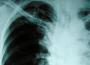 Tuberculose : les cas de résistance atteignent des niveaux alarmants