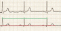 Electrocardiogramme : Comprendre l’ECG un défi osé ?