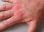 Hygiène des mains : plus de dermatites de contact irritative chez les professionnels de santé