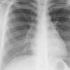 Recherche: Vaccin thérapeutique contre le cancer du poumon