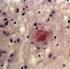 Un anticancéreux inverse rapidement Alzheimer chez des souris