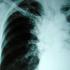 4000 personnes meurent chaque jour de la tuberculose