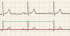 Electrocardiogramme : Comprendre l’ECG un défi osé ?