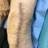 Plaies de prothèse : quel est le rôle de l’infirmière dans la détection des infections sur prothèses articulaires ?