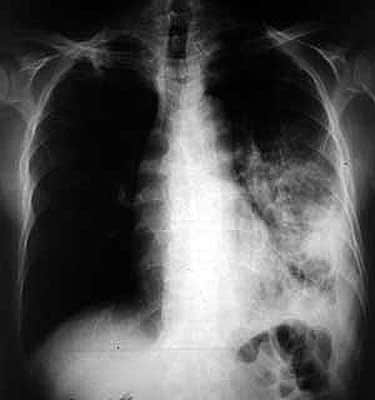 Doit-on craindre un retour de la tuberculose en France ? - Actusoins  actualité infirmière