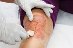 D.U Plaies et cicatrisation : une expertise infirmière