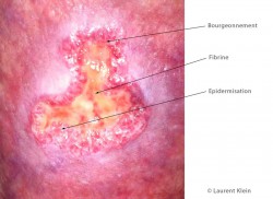 Plaie aiguë de plus de 30 jours présentant un retard de cicatrisation. La fibrine (jaune) empêche la plaie d'évoluer vers le bourgeonnement Cette plaie nécessite une détersion mécanique pour enlever la fibrine . 