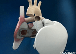 Troisième implantation d'un coeur artificiel Carmat