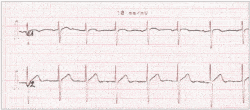 electrocardiogramme