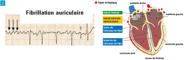 ECG electrocardiogramme fibrillation auriculaire