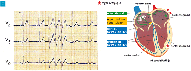 ECG electrocardiogramme les extrasystoles