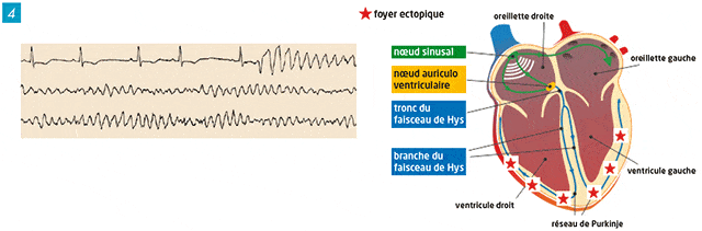 ECG electrocardiogramme fibrillation ventriculaire