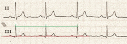 ECG electrocardiogramme frequence normale