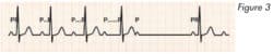 electrocardiogramme_troubles_conduction_fig3