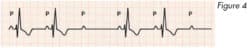 electrocardiogramme_troubles_conduction_fig4