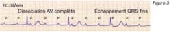 electrocardiogramme_troubles_conduction_fig5