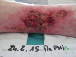 Traitement durant un mois d'une angiodermite nécrotique avec du miel Revamil sur une patiente de 81 ans.