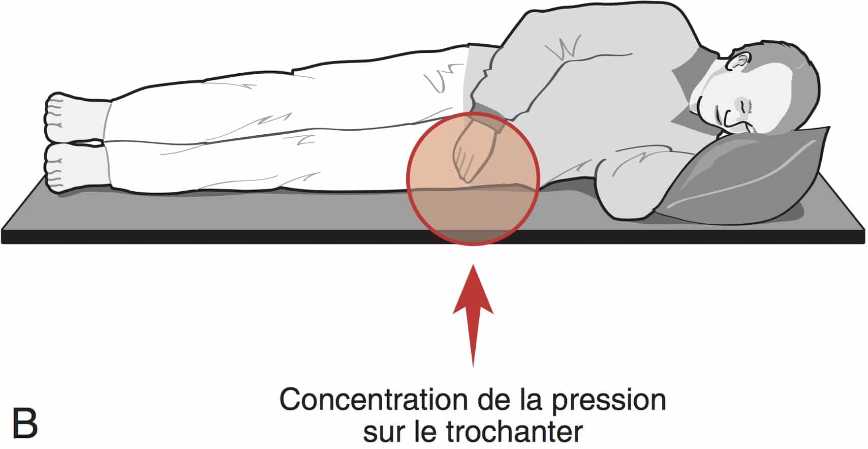 Escarres : l'échelle de Braden pour prédire le risque d'escarres ...