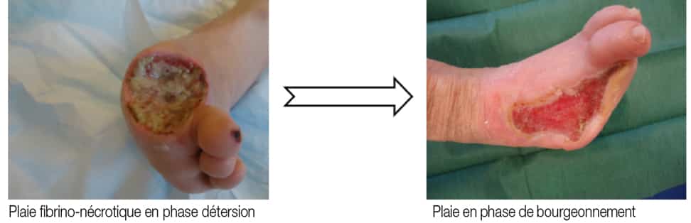 La détersion correspond à l’élimination des débris et des tissus inertes pour obtenir un milieu favorable à la cicatrisation