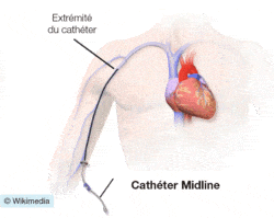 Cathéter Midline