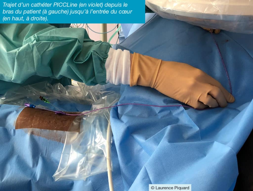 Trajet d'un cathéter PICCLIne