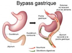 Schéma d’un bypass gastrique