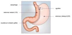 Schéma d’une sleeve gastrectomie