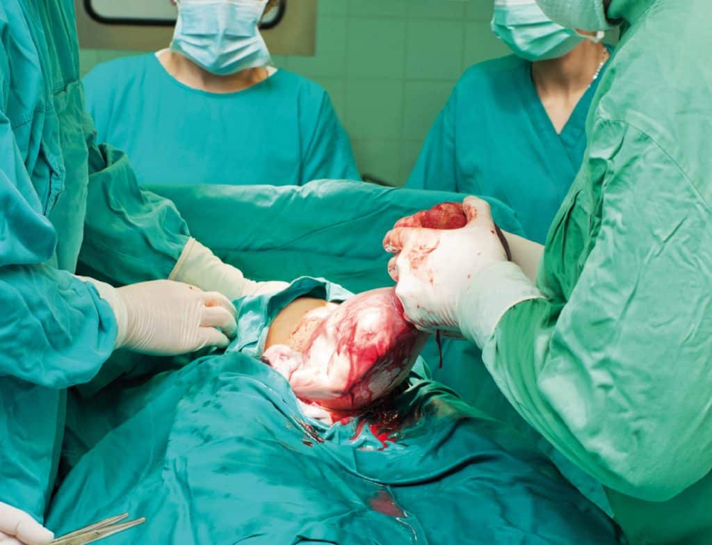 Prise en charge d’une patiente après césarienne Actusoins actualité