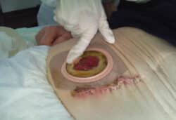 Application de la pâte hydrocolloïde pour les patients iléostomisés