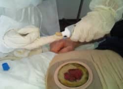 Application de la pâte hydrocolloïde pour les patients iléostomisés