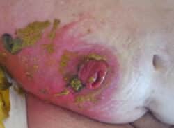 Brûlures sur stomies