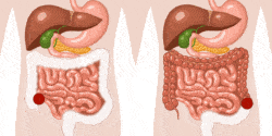 stomies digestives iléostomie colostomie
