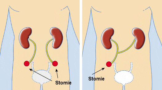 Urétérostomie cutanée unilatérale ou bilatérale