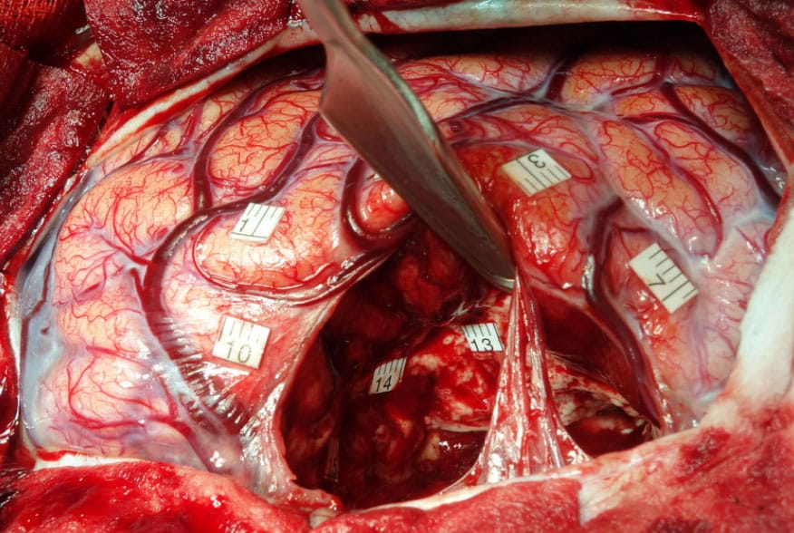Chirurgie éveillée du cerveau : l’hypnose remplace l’anesthésie Hypnose tumeur cerveau chirurgie chru tours