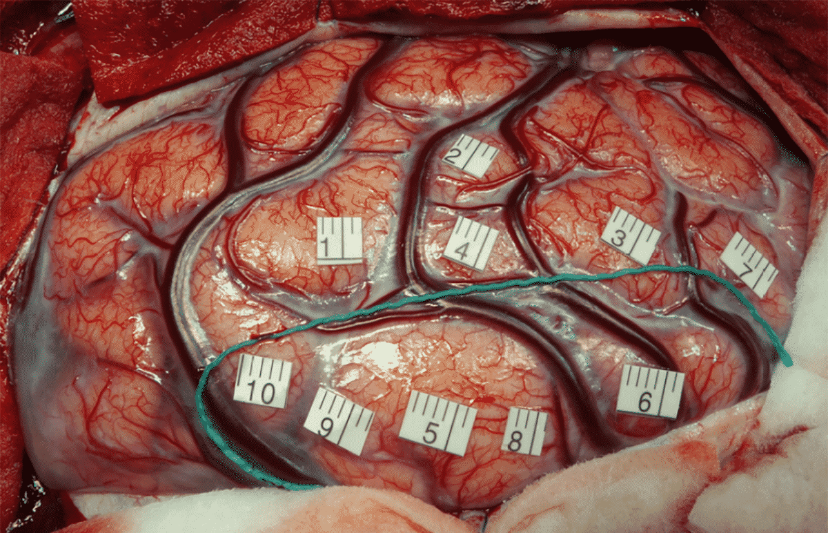 hypnose chirurgie éveillée de certaines tumeurs du cerveau : une première au Chru de Tours hypnose chirurgie eveillee chru tours