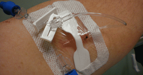 Cathétérisme veineux et antiseptiques : haro sur les idées reçues