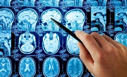 L’abus de benzodiazépines augmenterait le risque de maladie d’Alzheimer