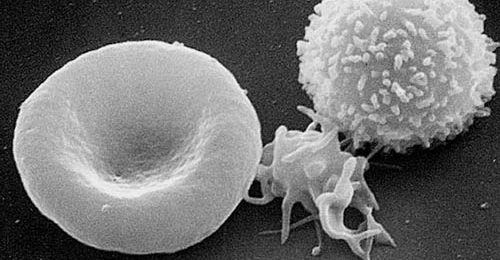 Leucémie : Un traitement prometteur Leucémie : Un traitement prometteur