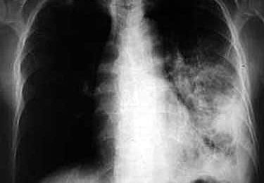 Doit-on craindre un retour de la tuberculose en France ?