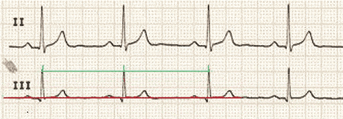 Electrocardiogramme : Comprendre l’ECG un défi osé ?