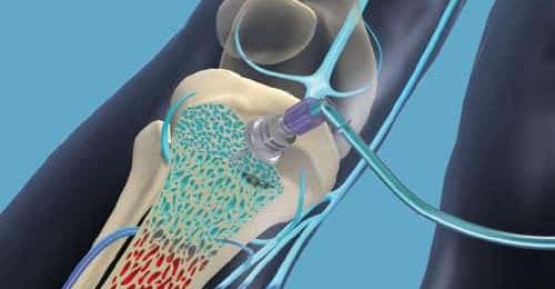 La perfusion intra osseuse : une voie d’abord à redécouvrir