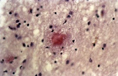 Un anticancéreux inverse rapidement Alzheimer chez des souris