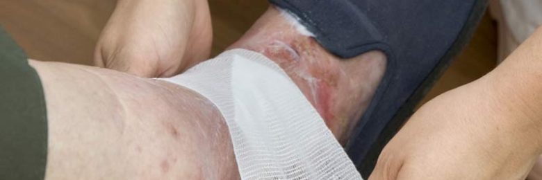 Les ulcères de jambe, du diagnostic au traitement