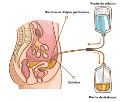 Solution de dialyse péritonéale