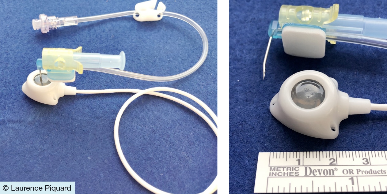 Le cathéter à chambre implantable, un dispositif médical aux multiples