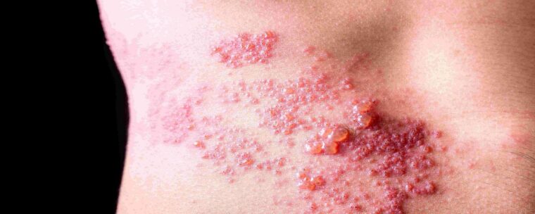 Le zona : un impact considérable sur la qualité de vie Le zona : un impact considérable sur la qualité de vie