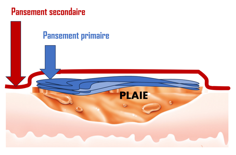 Pansement primaire et secondaire