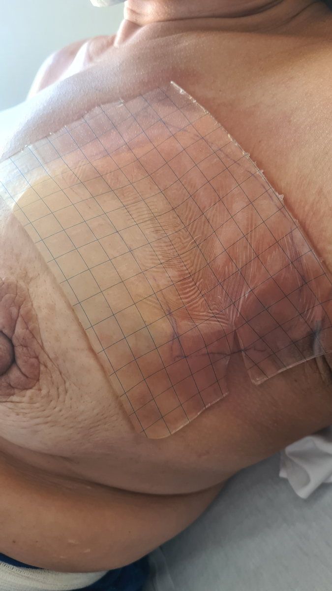 Pose du pansement en hydrogel